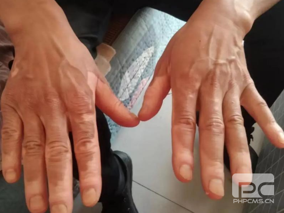 儿童白癜风护理要注意些什么？潍坊白癜风医院在什么地方？