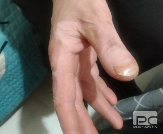 潍坊治疗白癜风去哪家医院好？白癜风中断治疗会怎么样？