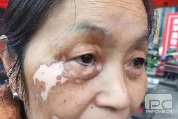 潍坊市看白癜风医院有哪些？儿童患上白癜风有哪些因素呢？