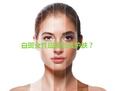 白斑女性应该怎么护理？